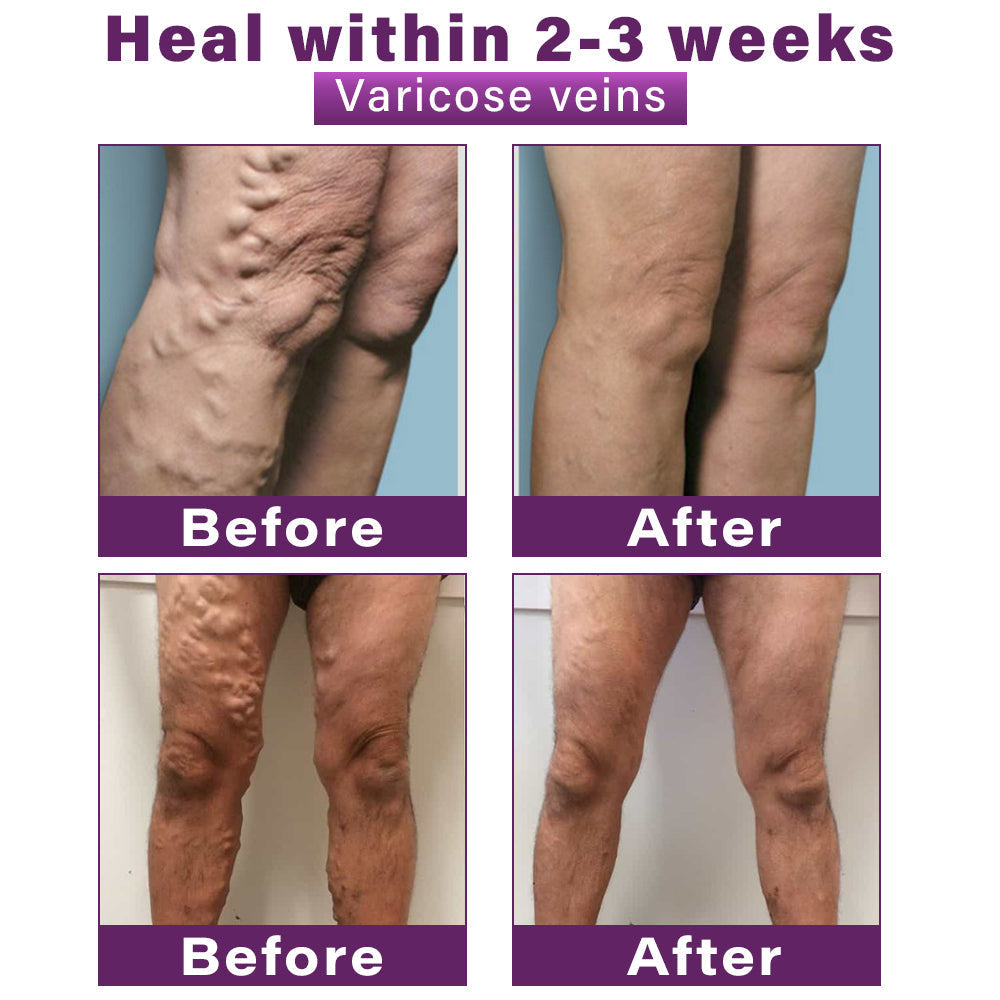 ✅GFOUK® Polidocanol Nano Varicose Vein Patch👩🏼⚕️Recommended by Irish College of Phlebology (Suitable for varicose veins, spider veins, and leg swelling)